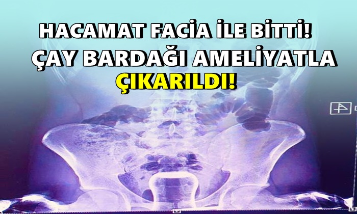 Hacamat faciayla bitti! Çay bardağı ameliyat ile çıkarıldı!