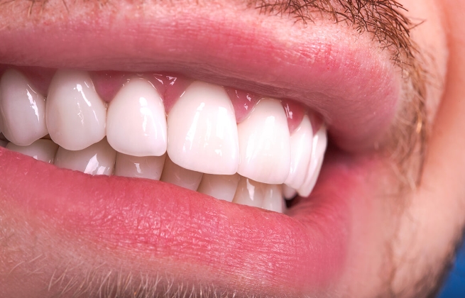 Zirkonyum Kaplama Fiyatları 