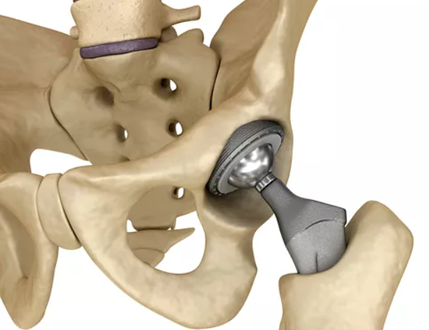Avasküler Nekroz Kök Hücre Tedavisi Kimlere Uygulanır?  