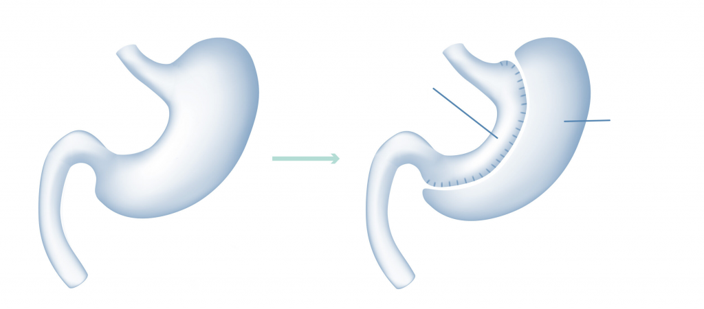 Tüp Mide Ameliyatı Sonrası Yaşam Tarzı Değişiklikleri Nelerdir