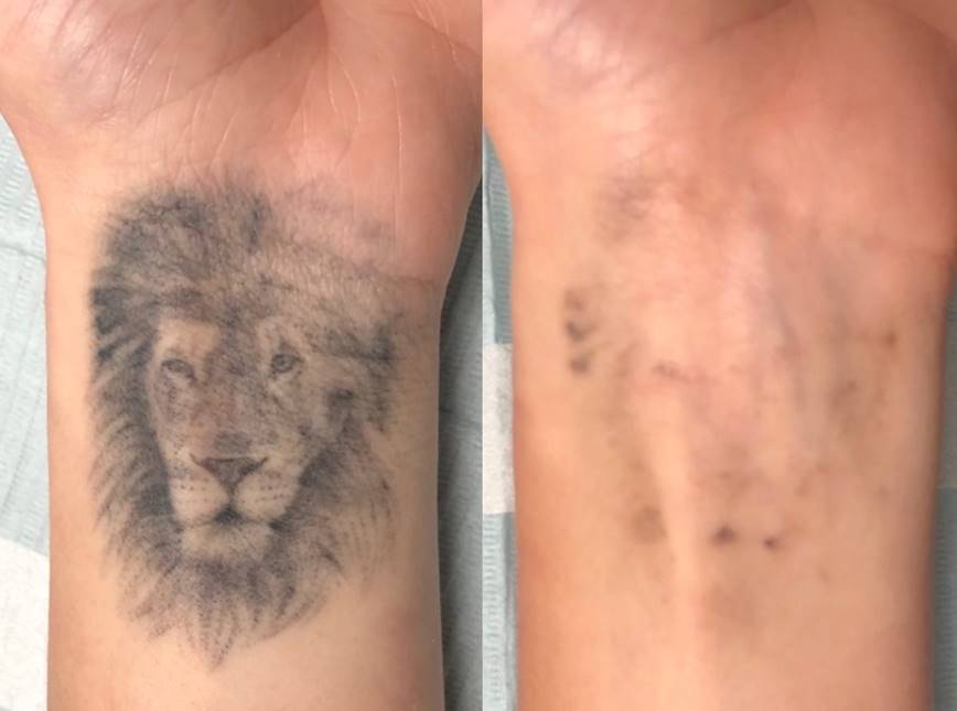 Antalya’nın En İyi Dövme Silme Merkezi