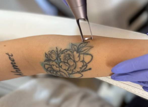 Lazer Dövme Sildirme Antalya ile Kaliteli İşlemler