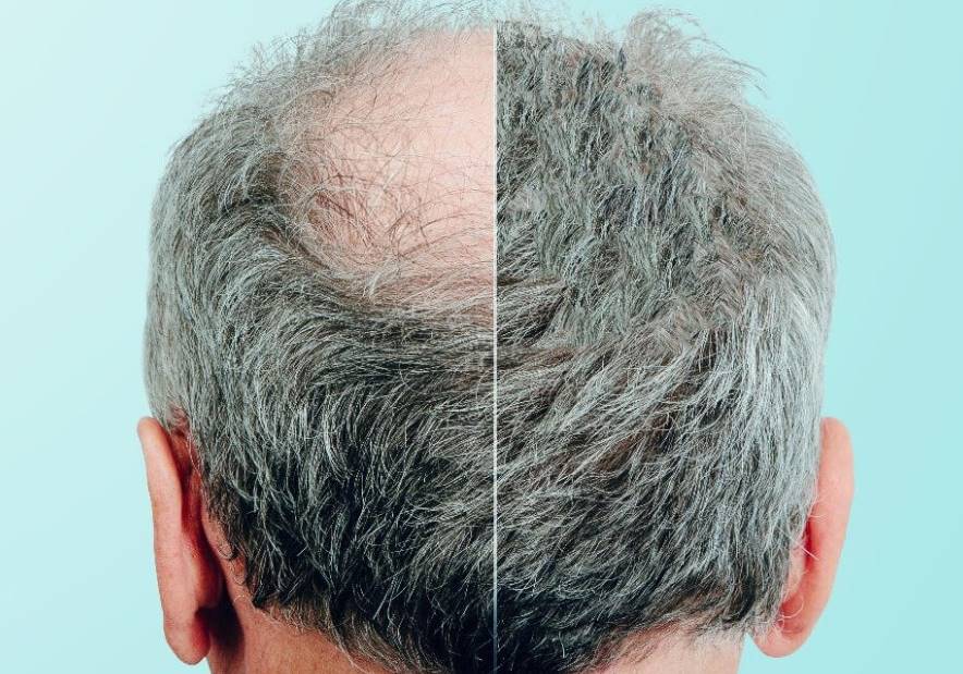 İnternational Saç Ekimi ile Yenilikçi Saç Restorasyonu Deneyimleri