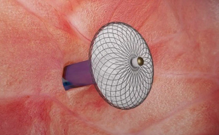 PFO Hakkında Merak Edilenler ve Tedavi Yöntemi